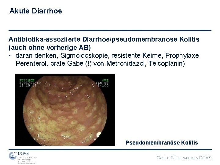 Akute Diarrhoe Antibiotika-assoziierte Diarrhoe/pseudomembranöse Kolitis (auch ohne vorherige AB) • daran denken, Sigmoidoskopie, resistente