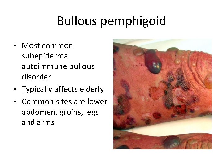 Bullous pemphigoid • Most common subepidermal autoimmune bullous disorder • Typically affects elderly •