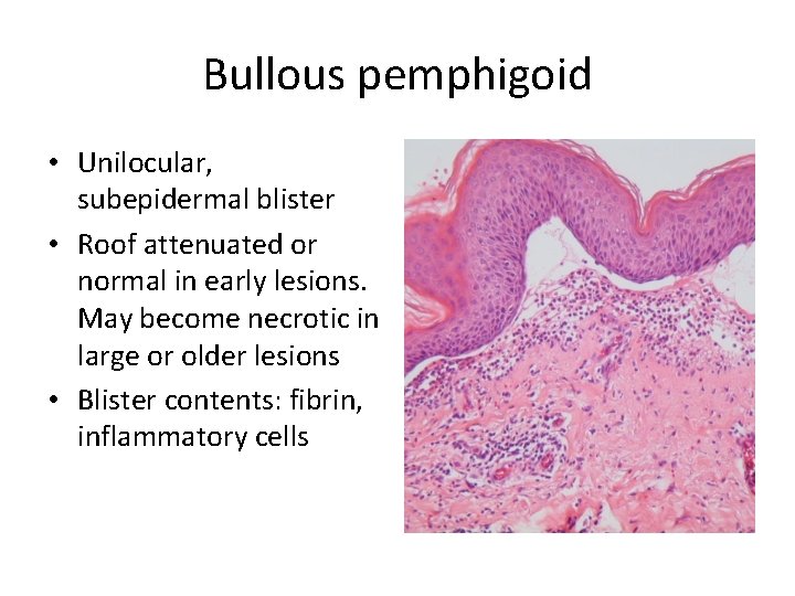 Bullous pemphigoid • Unilocular, subepidermal blister • Roof attenuated or normal in early lesions.