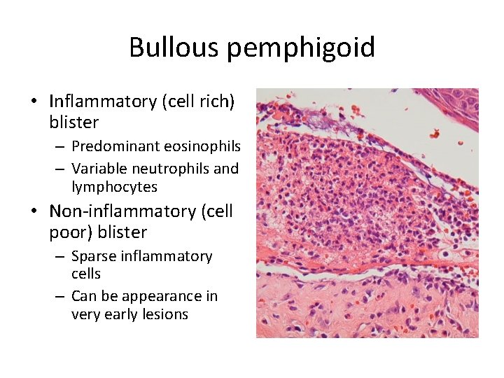 Bullous pemphigoid • Inflammatory (cell rich) blister – Predominant eosinophils – Variable neutrophils and