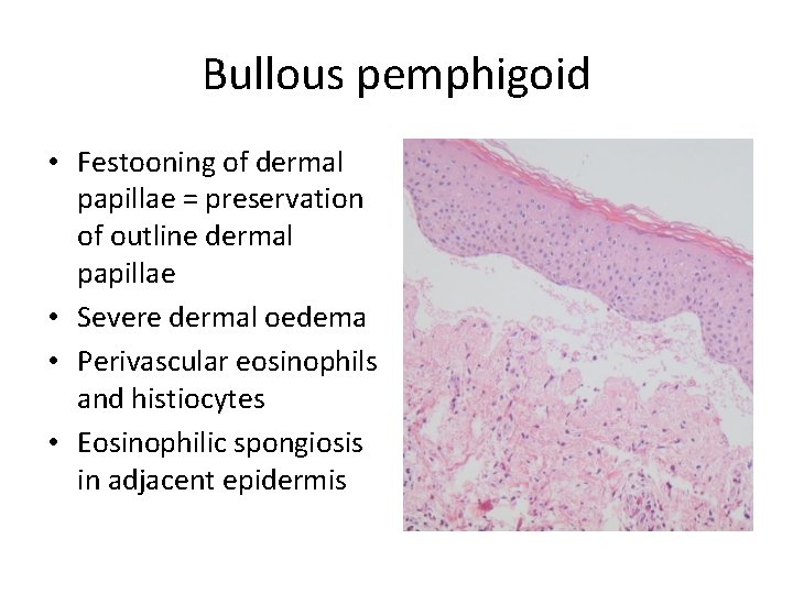 Bullous pemphigoid • Festooning of dermal papillae = preservation of outline dermal papillae •