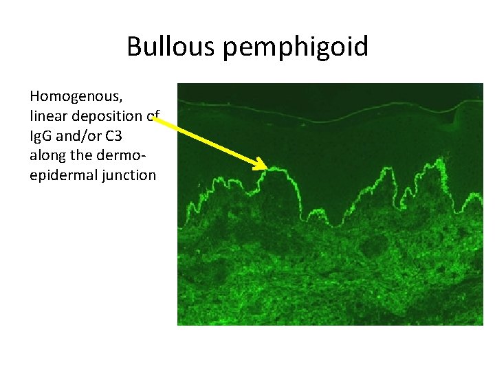 Bullous pemphigoid Homogenous, linear deposition of Ig. G and/or C 3 along the dermoepidermal