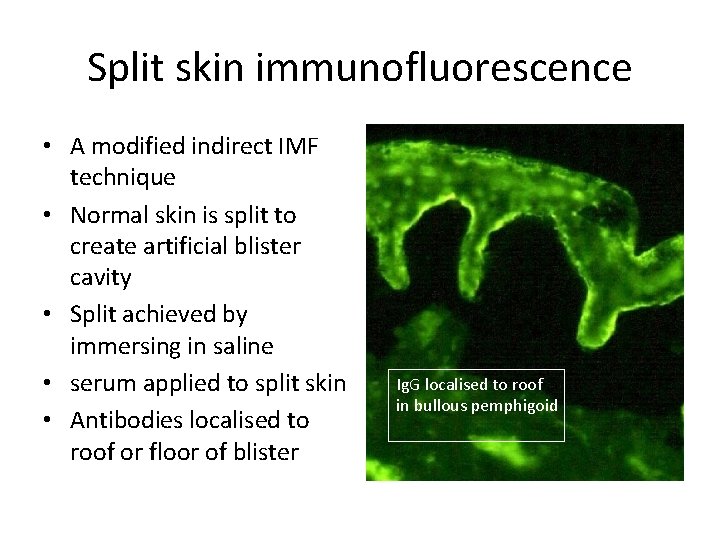 Split skin immunofluorescence • A modified indirect IMF technique • Normal skin is split