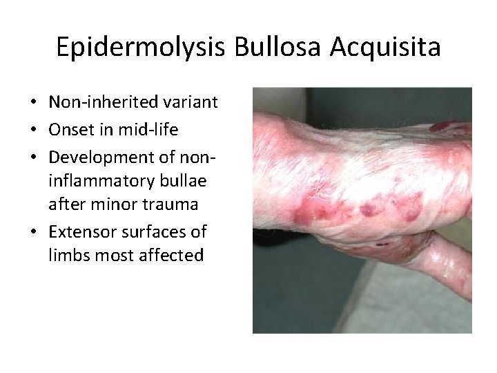 Epidermolysis Bullosa Acquisita • Non-inherited variant • Onset in mid-life • Development of noninflammatory