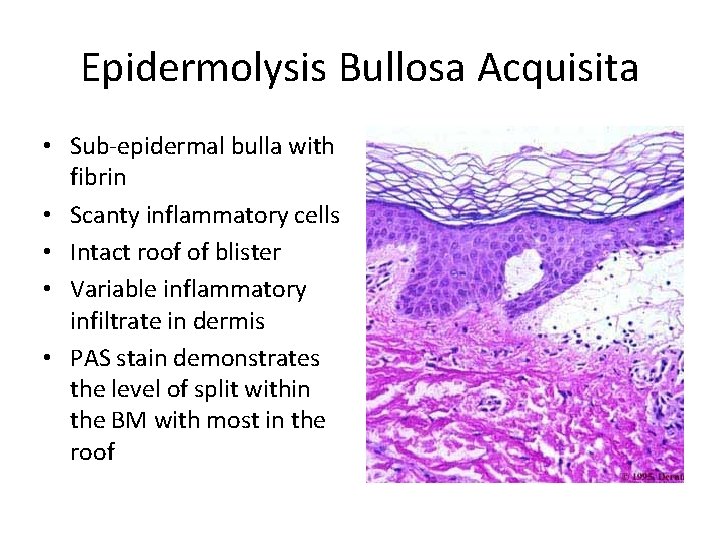 Epidermolysis Bullosa Acquisita • Sub-epidermal bulla with fibrin • Scanty inflammatory cells • Intact