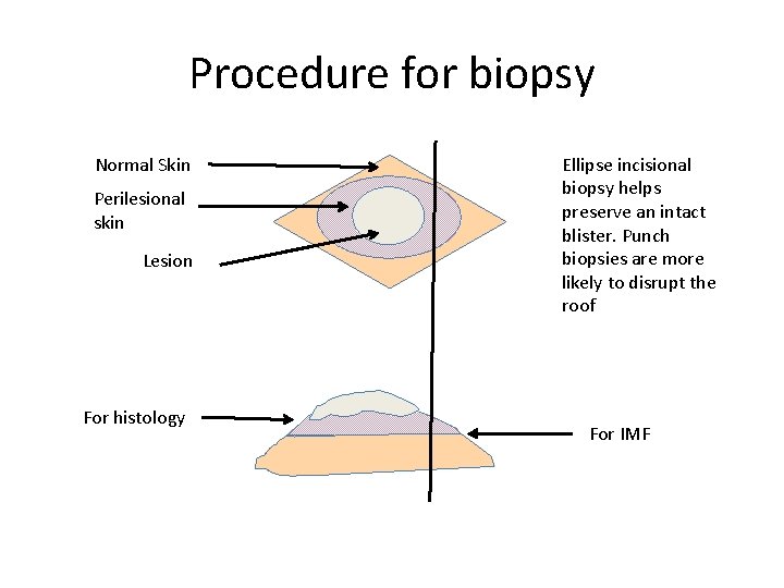 Procedure for biopsy Normal Skin Perilesional skin Lesion For histology Ellipse incisional biopsy helps