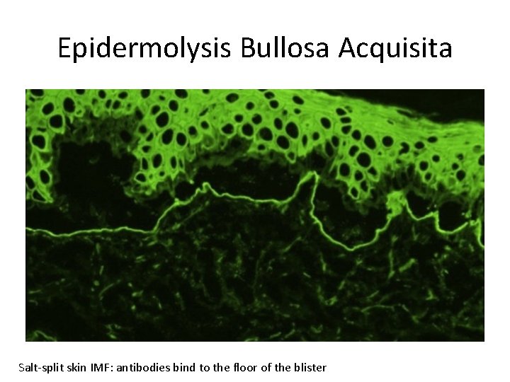 Epidermolysis Bullosa Acquisita Salt-split skin IMF: antibodies bind to the floor of the blister