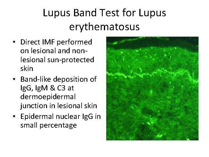 Lupus Band Test for Lupus erythematosus • Direct IMF performed on lesional and nonlesional
