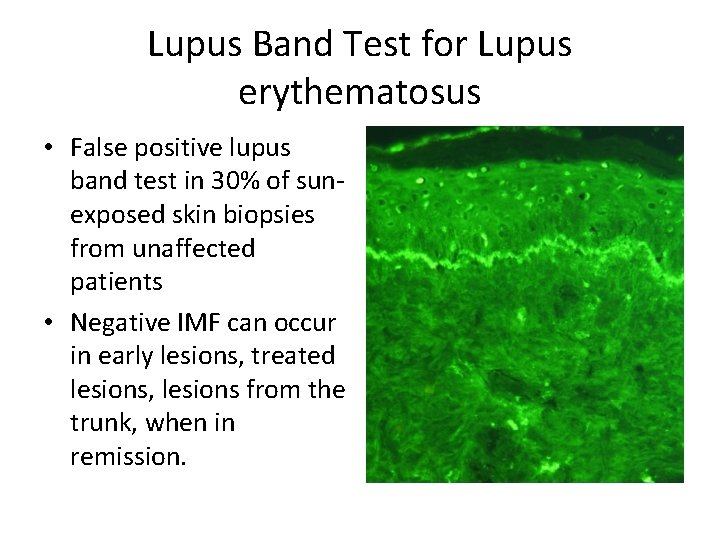 Lupus Band Test for Lupus erythematosus • False positive lupus band test in 30%