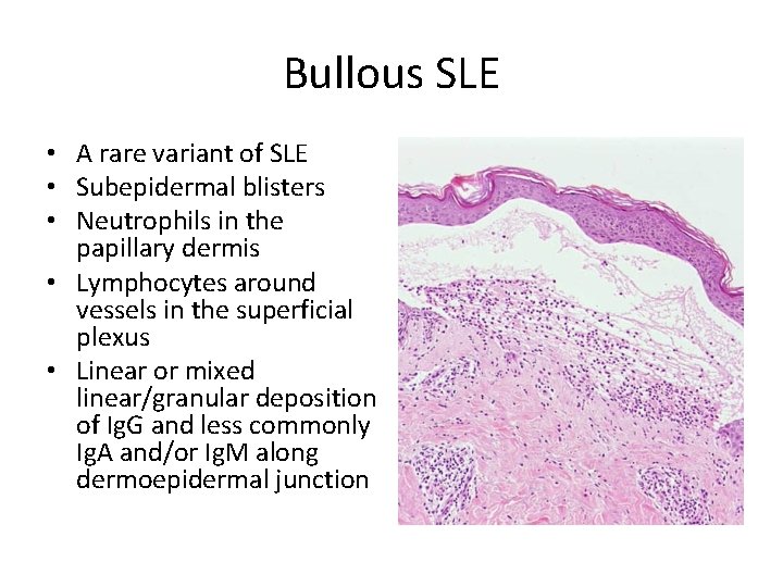 Bullous SLE • A rare variant of SLE • Subepidermal blisters • Neutrophils in