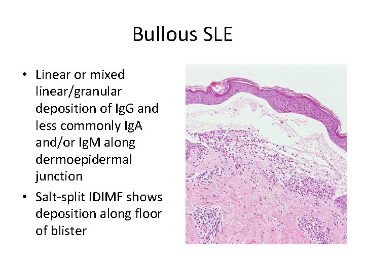 Bullous SLE • Linear or mixed linear/granular deposition of Ig. G and less commonly