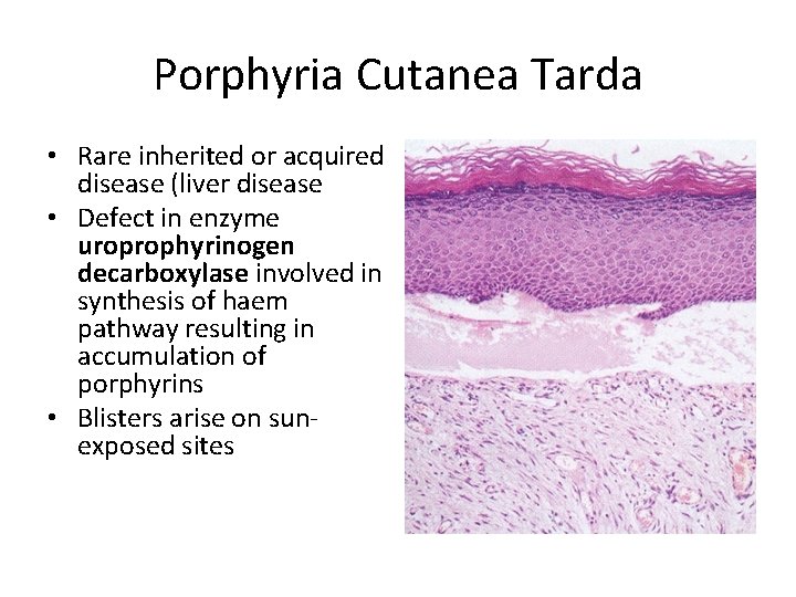 Porphyria Cutanea Tarda • Rare inherited or acquired disease (liver disease • Defect in