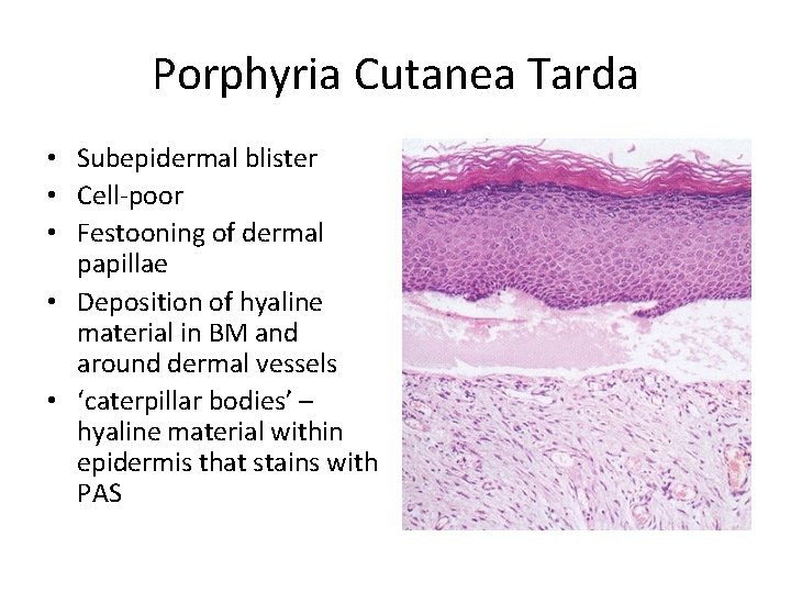 Porphyria Cutanea Tarda • Subepidermal blister • Cell-poor • Festooning of dermal papillae •