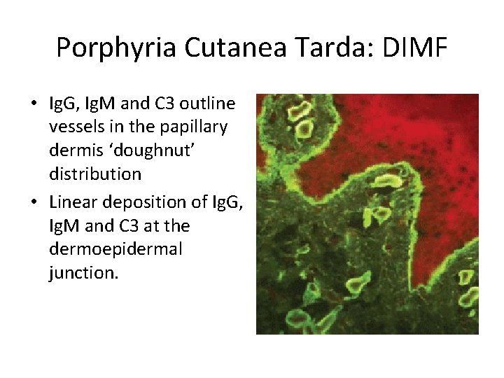 Porphyria Cutanea Tarda: DIMF • Ig. G, Ig. M and C 3 outline vessels