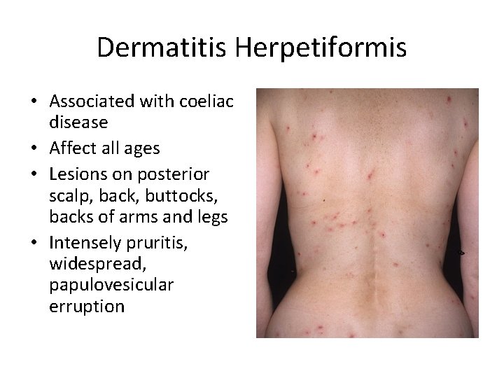 Dermatitis Herpetiformis • Associated with coeliac disease • Affect all ages • Lesions on