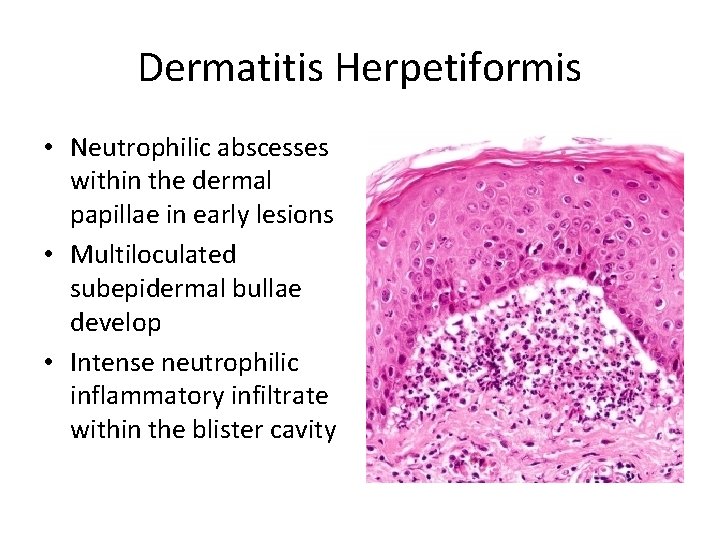 Dermatitis Herpetiformis • Neutrophilic abscesses within the dermal papillae in early lesions • Multiloculated