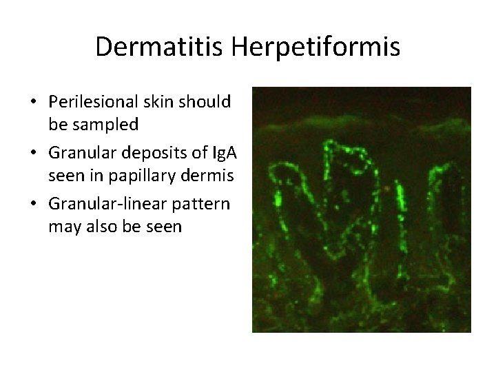 Dermatitis Herpetiformis • Perilesional skin should be sampled • Granular deposits of Ig. A