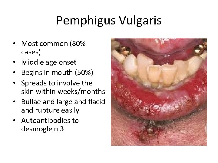 Pemphigus Vulgaris • Most common (80% cases) • Middle age onset • Begins in