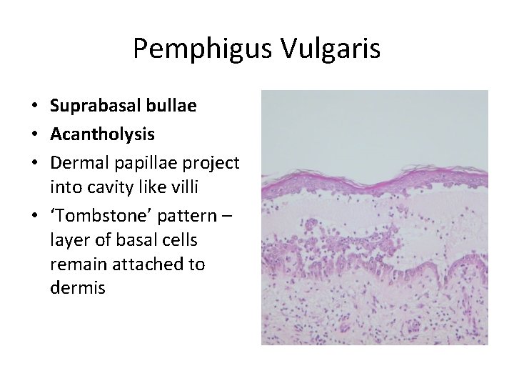 Pemphigus Vulgaris • Suprabasal bullae • Acantholysis • Dermal papillae project into cavity like