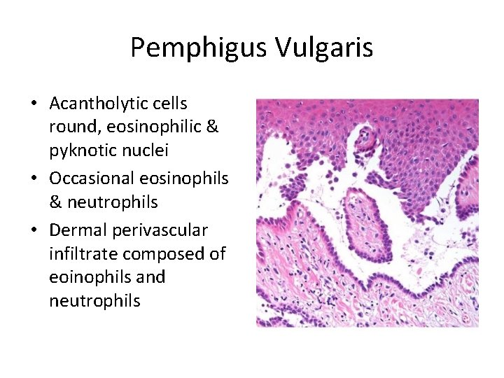 Pemphigus Vulgaris • Acantholytic cells round, eosinophilic & pyknotic nuclei • Occasional eosinophils &