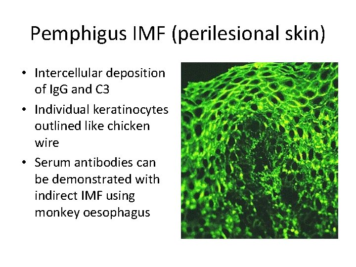 Pemphigus IMF (perilesional skin) • Intercellular deposition of Ig. G and C 3 •
