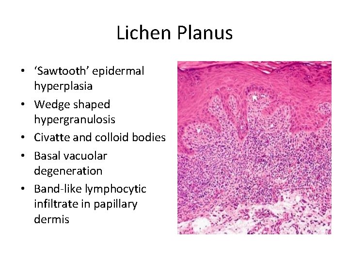 Lichen Planus • ‘Sawtooth’ epidermal hyperplasia • Wedge shaped hypergranulosis • Civatte and colloid