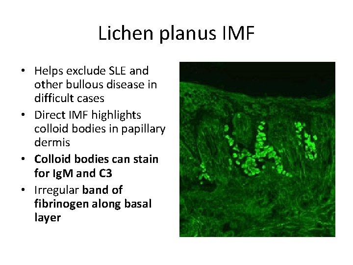 Lichen planus IMF • Helps exclude SLE and other bullous disease in difficult cases