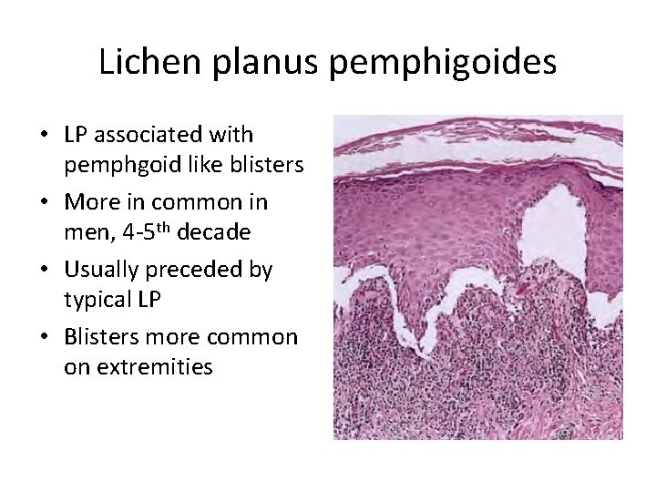 Lichen planus pemphigoides • LP associated with pemphgoid like blisters • More in common