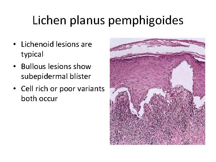 Lichen planus pemphigoides • Lichenoid lesions are typical • Bullous lesions show subepidermal blister