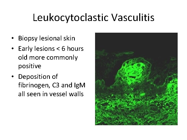 Leukocytoclastic Vasculitis • Biopsy lesional skin • Early lesions < 6 hours old more