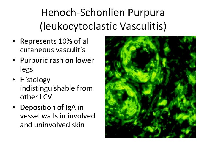 Henoch-Schonlien Purpura (leukocytoclastic Vasculitis) • Represents 10% of all cutaneous vasculitis • Purpuric rash