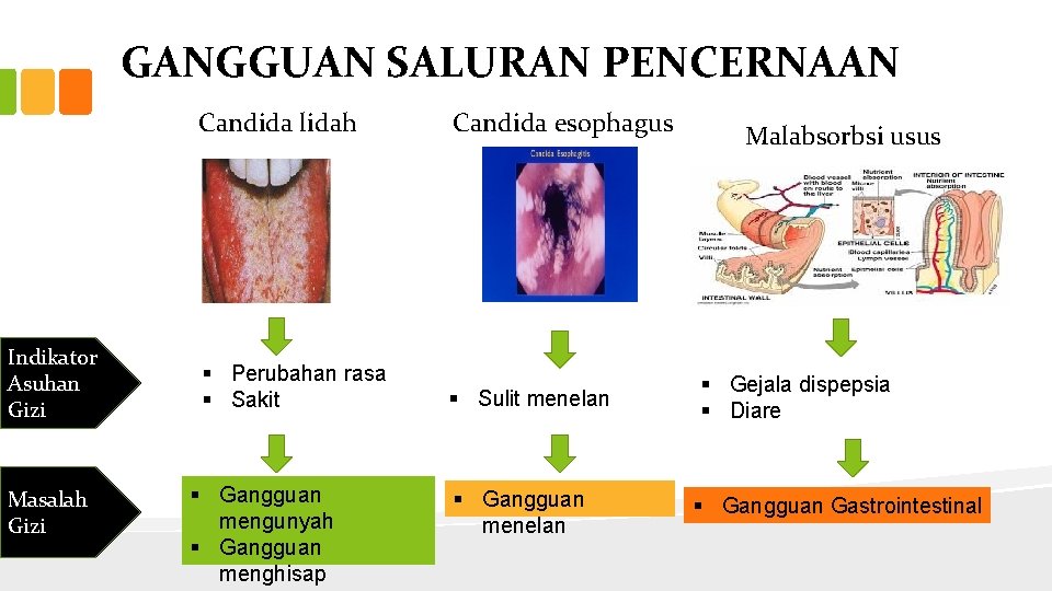 GANGGUAN SALURAN PENCERNAAN Indikator Asuhan Gizi Masalah Gizi Candida lidah Candida esophagus § Perubahan
