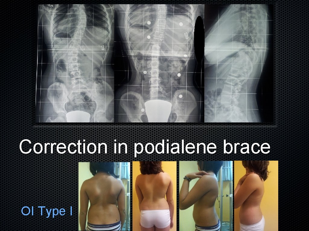 Correction in podialene brace OI Type I 