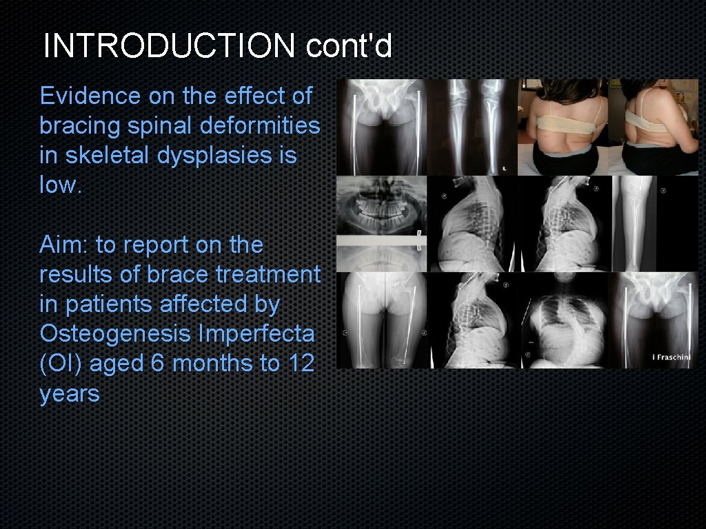 INTRODUCTION cont'd Evidence on the effect of bracing spinal deformities in skeletal dysplasies is