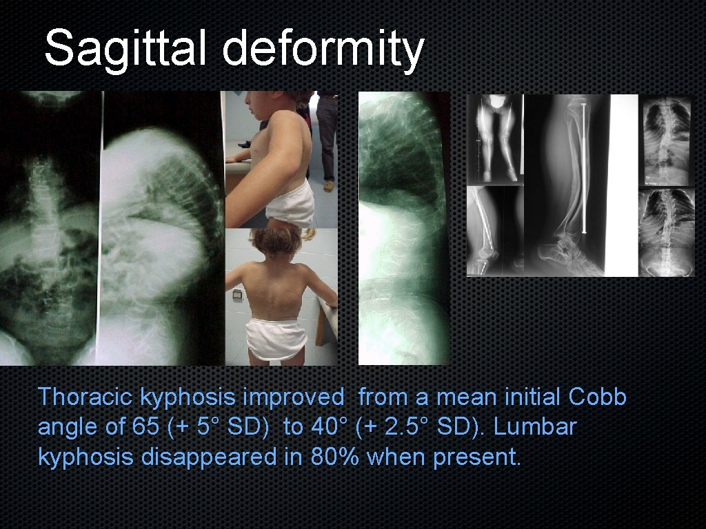 Sagittal deformity Thoracic kyphosis improved from a mean initial Cobb angle of 65 (+