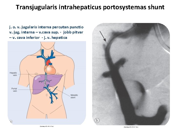 Transjugularis intrahepaticus portosystemas shunt j. o. v. jugularis interna percutan punctio v. jug. interna