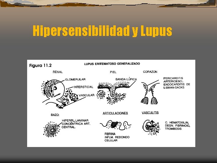 Hipersensibilidad y Lupus 