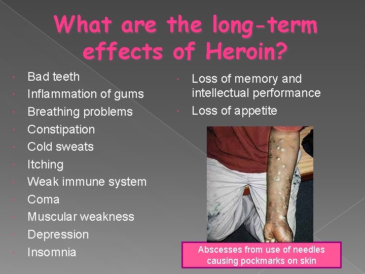 What are the long-term effects of Heroin? Bad teeth Inflammation of gums Breathing problems