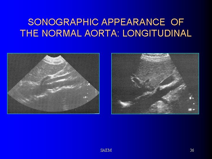 SONOGRAPHIC APPEARANCE OF THE NORMAL AORTA: LONGITUDINAL SAEM 36 