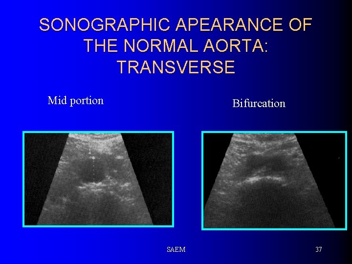 SONOGRAPHIC APEARANCE OF THE NORMAL AORTA: TRANSVERSE Mid portion Bifurcation SAEM 37 