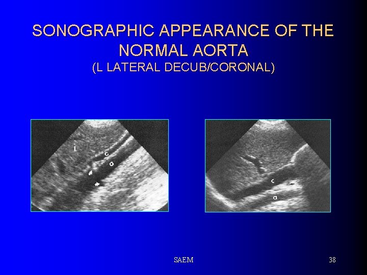 SONOGRAPHIC APPEARANCE OF THE NORMAL AORTA (L LATERAL DECUB/CORONAL) SAEM 38 