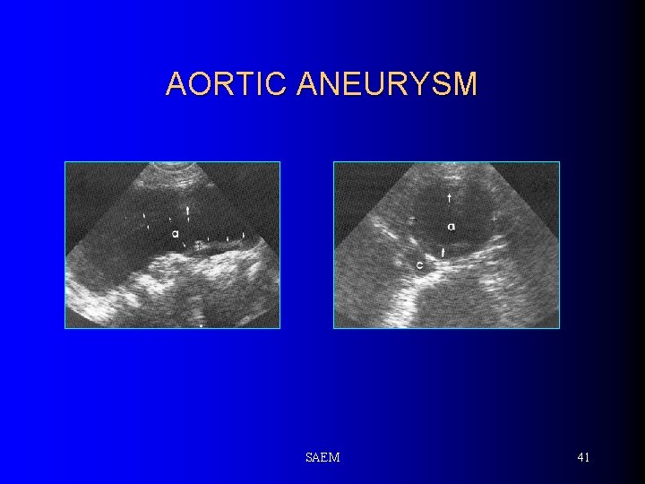 AORTIC ANEURYSM SAEM 41 
