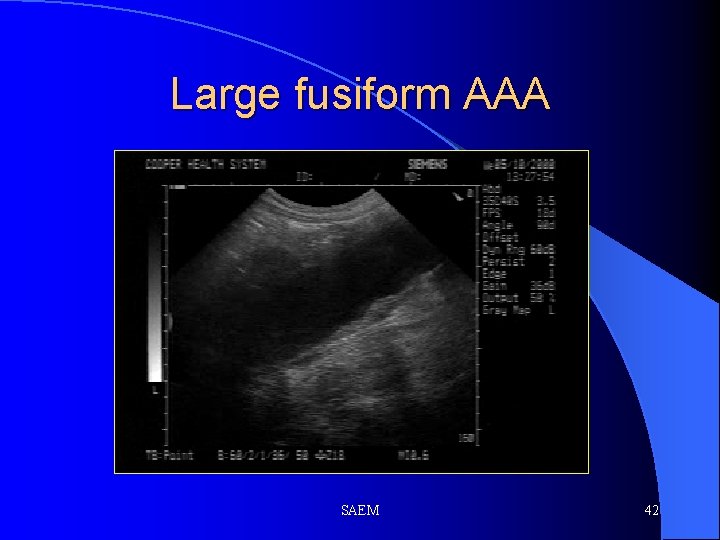 Large fusiform AAA SAEM 42 