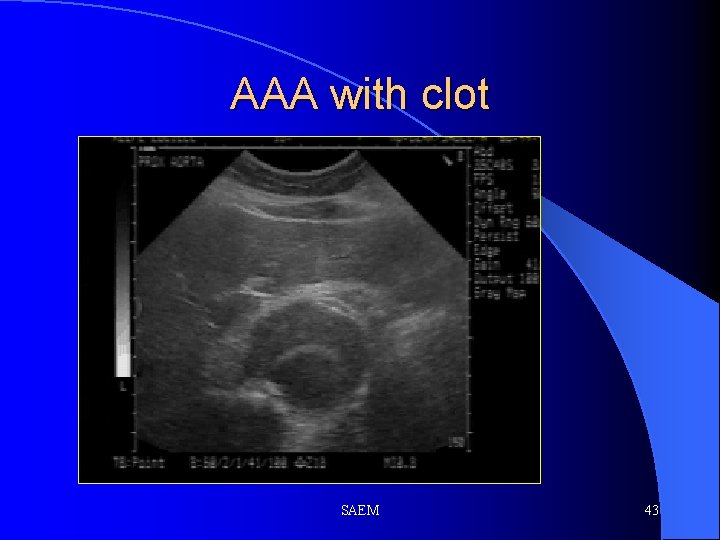 AAA with clot SAEM 43 