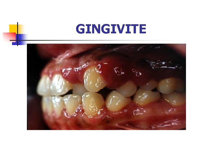 GINGIVITE 