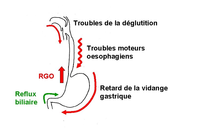 Schéma simple Troubles de la déglutition Troubles moteurs oesophagiens RGO Reflux biliaire Retard de