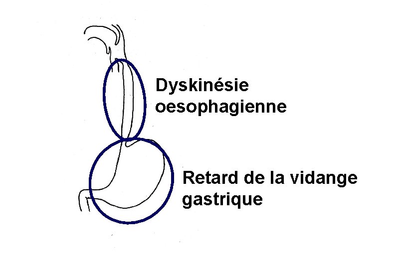 Dyskinésie oesophagienne Retard de la vidange gastrique 