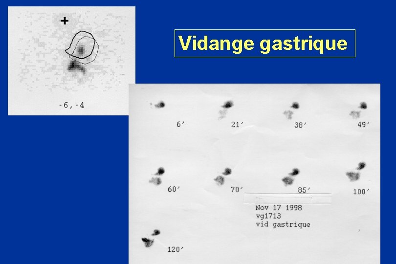 Vidange gastrique 