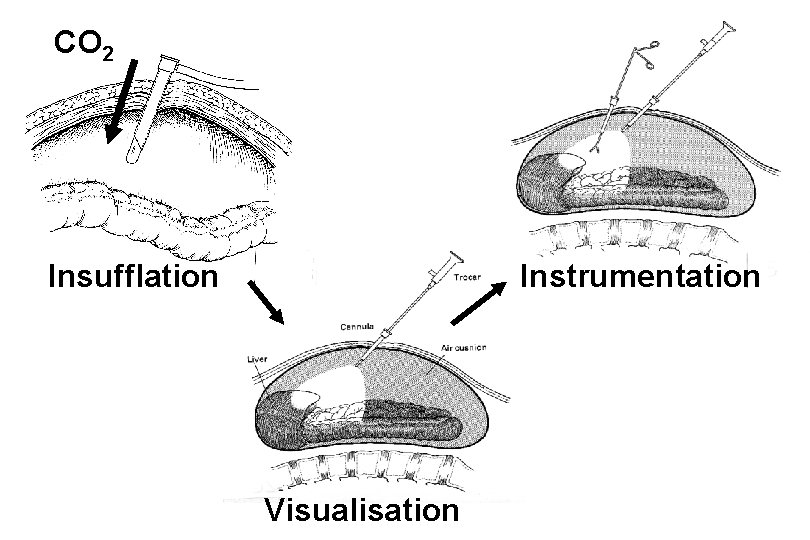 CO 2 Insufflation Instrumentation Visualisation 