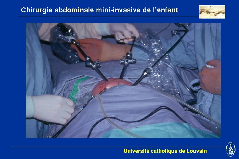 Chirurgie abdominale mini-invasive de l’enfant Université catholique de Louvain 
